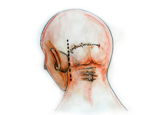 Retrosigmoid Approach D Atlas Of Neurological Surgery