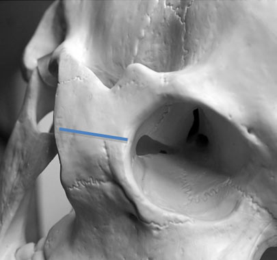 Fronto-orbito-zygomatic approach and its variations - 3D Atlas of ...