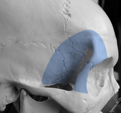 Fronto-orbito-zygomatic approach and its variations - 3D Atlas of ...