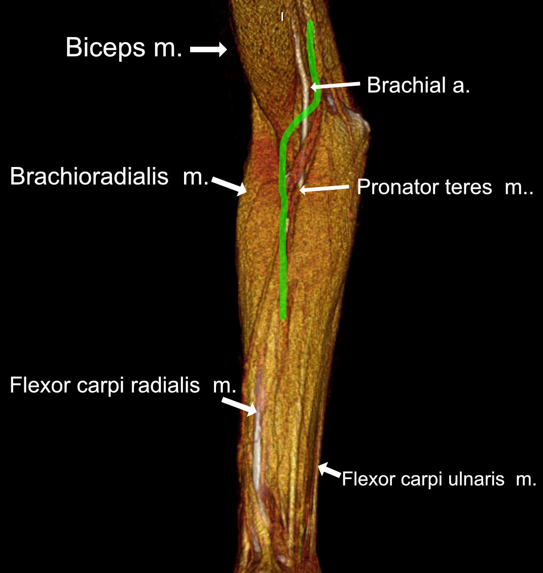 Anterior interosseous nerve - 3D Atlas of Neurological Surgery