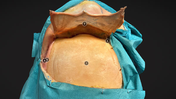 Transbasal Approach Advanced Cranial Approaches - 3D Atlas of Neurological Surgery